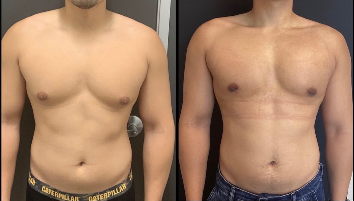 Gynecomastia correction, after