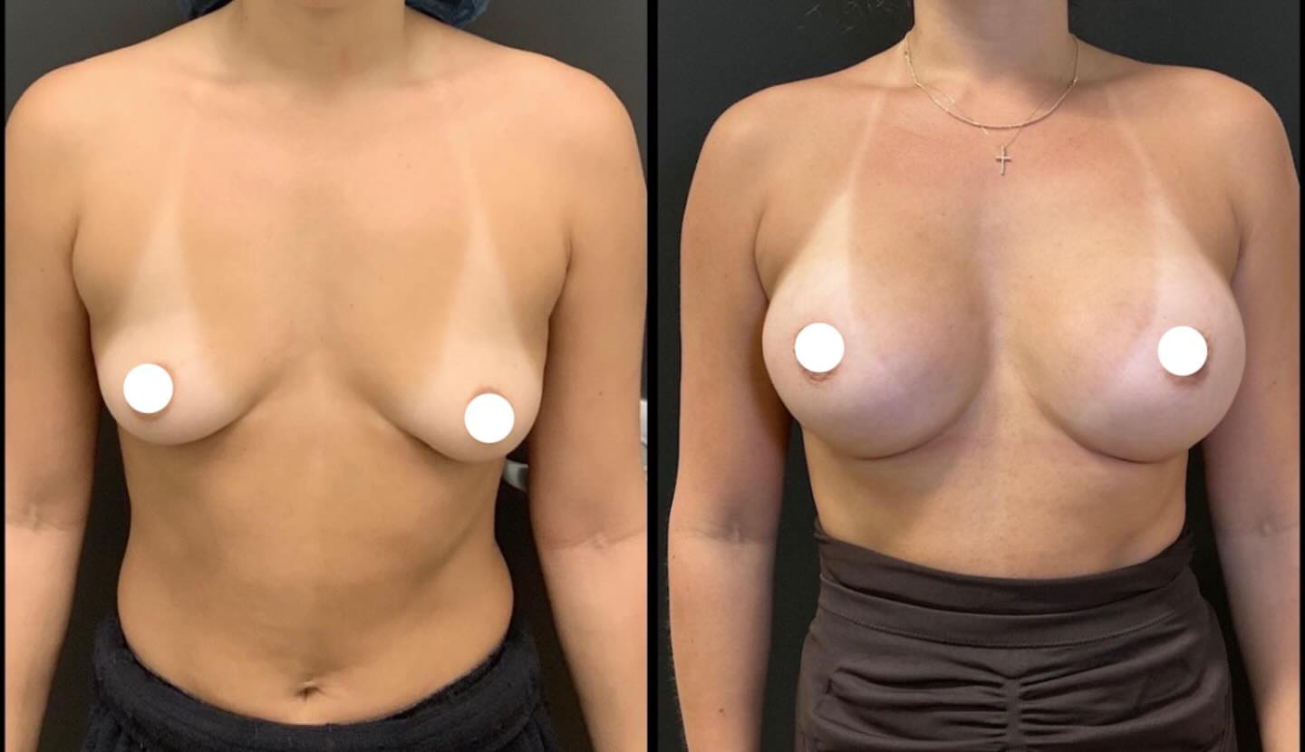 Breast augmentation, before
