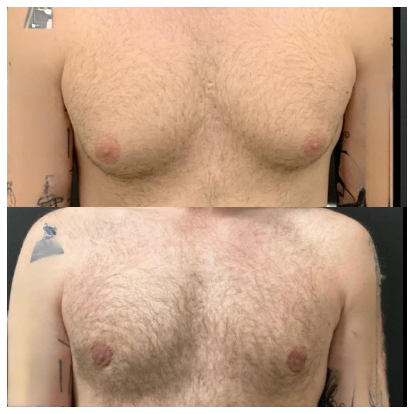 Gynecomastia correction, before