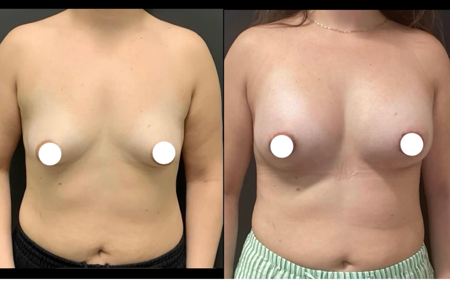 Breast augmentation before-and-after documentation