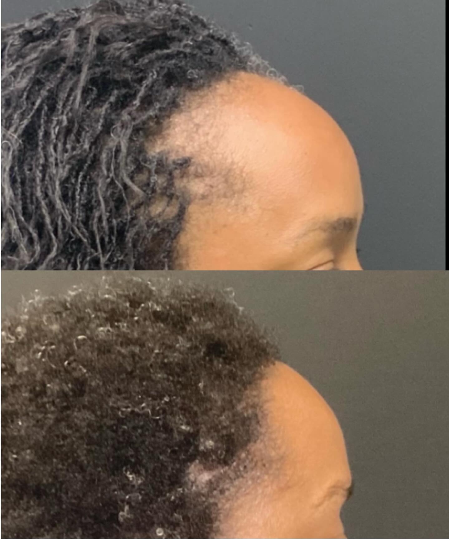 Before and after hair restoration result showing a restored hairline