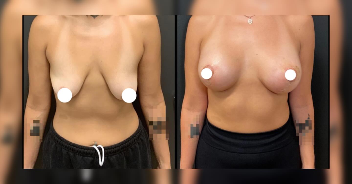 Before and after breast lift result restoring shape and position, nipples censored