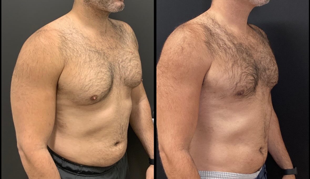 Gynecomastia before-and-after documentation