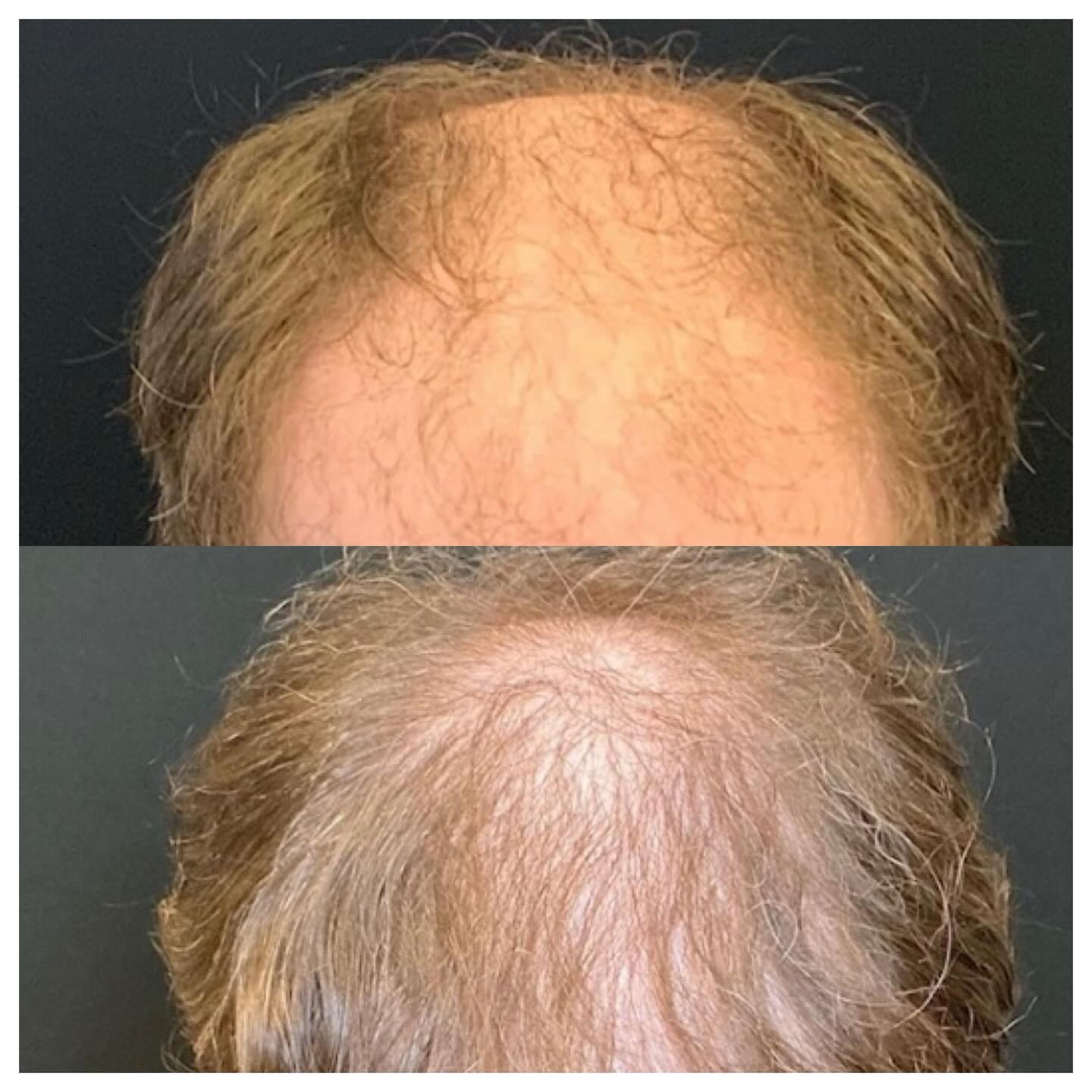 Before and after hair restoration result, top view showing increased coverage